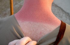 This patch will say you're at risk of being sunburned before it happens