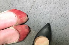 This viral photo of a waitress' feet after her shift illustrates why heels are EVIL