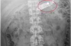 Pictures: The case of a Dublin prisoner who swallowed a mobile phone