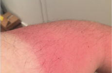 Here's why a farmer's tan is the hottest look this summer