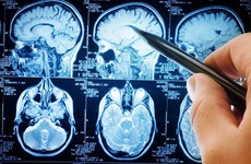 College graduates at higher risk of cancerous brain tumours, researchers find