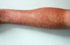 Person with measles travelled by plane to Dublin and then onto Galway