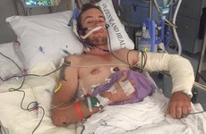 Irishman 'burnt to the bone' after sleeping bag caught fire at Australian rodeo