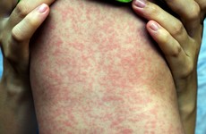 People urged to get vaccinated as latest case of measles confirmed in Cork