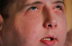 US firefighter can drive and swim again one year after face transplant