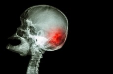 Patients needing urgent brain surgery are turned away from Ireland's second-biggest hospital