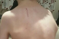 "Waiting times are not acceptable": Minister insists every effort being made to help children with scoliosis