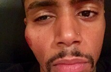 Boxer forced to pull out of British title fight after 'brick' attack