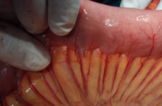 Humans have a new organ and it's thanks to surgeons in Limerick