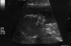 Simple blood test could identify foetal gender in early stages of pregnancy: study