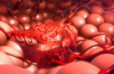 The Royal College of Surgeons is tackling treatment-resistant tumours