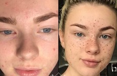 People are getting freckles tattooed on their faces in the name of beauty