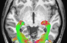 Scientists find visual symptoms that could help early detection of Parkinson's