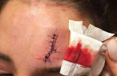 Former Miss Cork's head split open by beer bottle at Longitude festival in Dublin