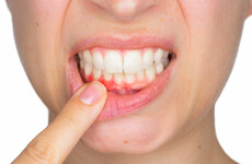 Women with history of gum disease at higher risk of cancer, study says