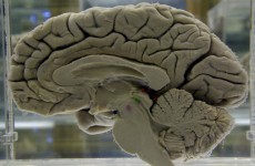 NUIG researchers discover enzyme linked with Huntington’s disease mutation