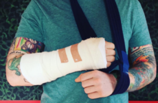 Ed Sheeran has broken his arm after being knocked down in London