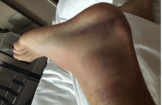 Ronnie O'Sullivan overcomes swollen ankle and runner exemption to progress at English Open