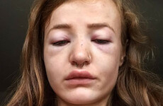 'I thought this could be it,' says 18-year-old student who was assaulted in Letterkenny