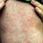 People urged to get vaccinated as two measles cases confirmed in Dublin