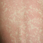 People with measles symptoms advised to isolate themselves as highly contagious disease spreads
