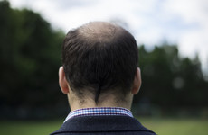Baldness and premature greying linked to increased risk of early heart disease in men