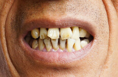 Irish research links bacteria to pre-oral cancer growth