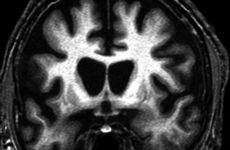 A huge breakthrough has been made that could stop the devastating Huntington’s disease