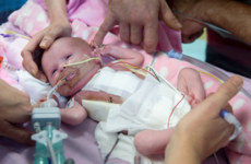 Baby girl born with heart outside her chest survives three surgeries