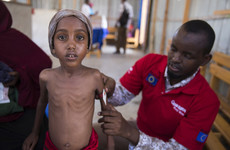This malnourished 5-year-old girl had her life saved thanks to Irish donations