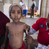 This malnourished 5-year-old girl had her life saved thanks to Irish donations