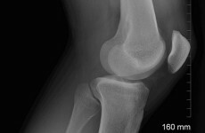 Further study needed on effectiveness of knee implants - report