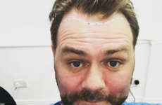 Brian McFadden got a hair transplant and shared all the gory details on Instagram