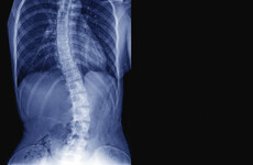 'Aisling's curve is now 70%': Minister says waiting four years for scoliosis surgery is too long