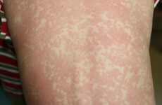 Forty cases of measles now confirmed across the country
