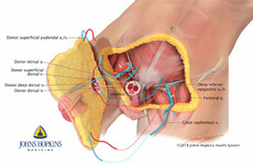World's first total penis and scrotum transplant takes place in US