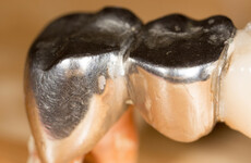 Dentists will stop using metal fillings that have been used in teeth for 150 years