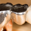 Dentists will stop using metal fillings that have been used in teeth for 150 years