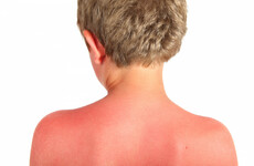Children's hospital pleads with parents to keep their children protected from the sun