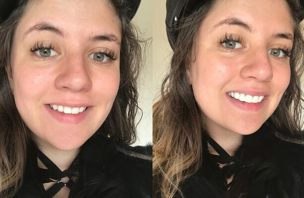 So Here S What Happened When I Got Clip In Veneers The Daily Edge