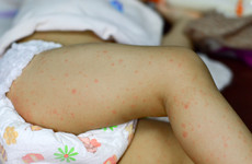 HSE issues warning after two confirmed cases of measles in Dublin
