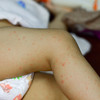 HSE issues warning after two confirmed cases of measles in Dublin