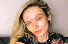 Huda Beauty was criticised for shaming this YouTuber over her acne scars