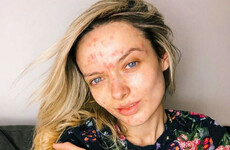 Huda Beauty was criticised for shaming this YouTuber over her acne scars