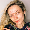 Huda Beauty was criticised for shaming this YouTuber over her acne scars
