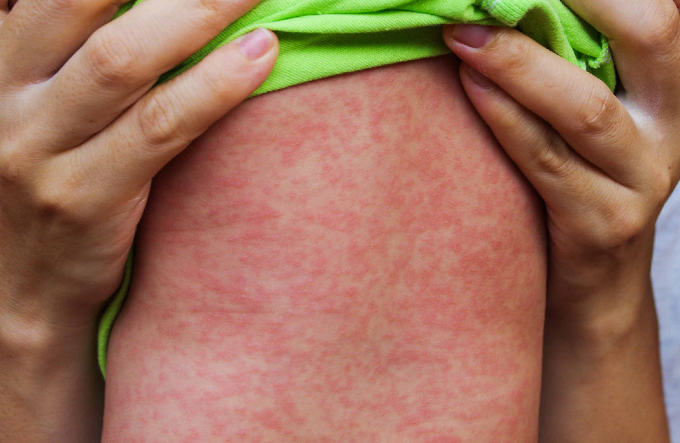 Warning Issued As Four Cases Of Measles Are Reported In Dublin   River