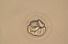 Babies born through IVF may have twice the risk of cerebral palsy