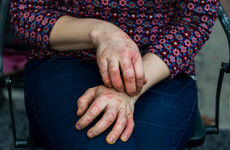 Bee venom may be effective in treating common skin condition eczema, study finds