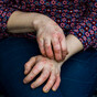 Bee venom may be effective in treating common skin condition eczema, study finds