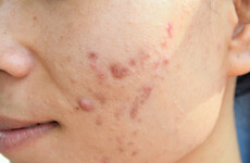 Beauty Q: Do 'acne positive' Instagram accounts make you feel more confident about your skin?